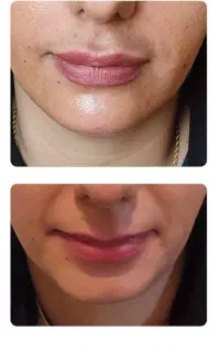 ژل، بوتاکس مزوتراپی prp فقط 790