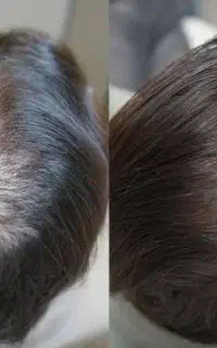 معجزه قطع ریزش و پرپشتی مو