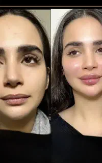 تزریق ژل و بوتاکس درکلینیک