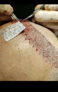 کاشت مو
