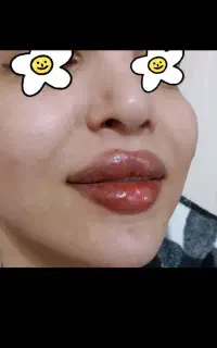 تزریق ژل و بوتاکس و آموزش