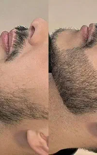 رویش ریش و سیبیل پرپشت و جذاب