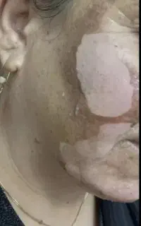 لایه برداری پوست درمان لک
