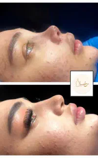 جراحی بینی بدون بیهوشی فقط ۲۰