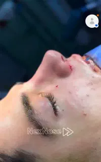 رینوپلاستی(جراحی بینی)فقط37میلیون با شرایط اقساط