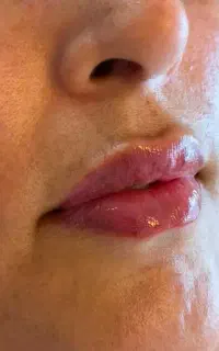 ژل بوتاکس مزو کربوکسی