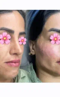 خدمات تخصصی فیلرژل بوتاکس فیلربادی فیشیال پی ارپی