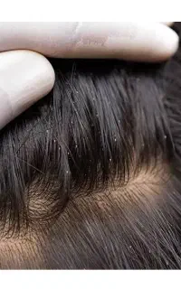 حذف واقعی شپش با رضایت