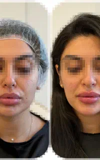 زاویه سازی صورت و فرم دهی طبیعی تخصصی