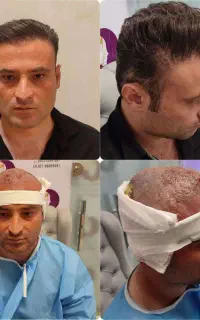 کاشت مو و ابرو به روش شیرازی با گارانتی کتبی
