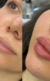 تزریق فیلر و بوتاکس کره ای
