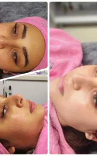 فیشال تضمینی لک و کک و مک و جوش
