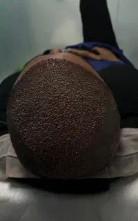 کاشت مو و ابرو و ریش با پیش پرداخت ۶ میلیون