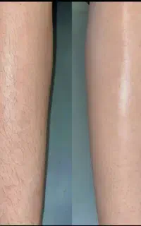 لیزر مو جوابدهی تضمینی