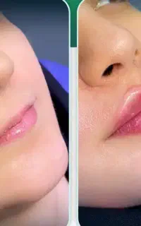 جشنواره ژل بوتاکس ،زاویه اراف فول فیس ،
