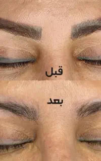ریموو تاتو
