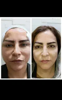 مینی لیفت صورت با جراحی سرپایی و بی حسی موضعی