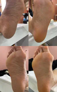 اپیلاسیون