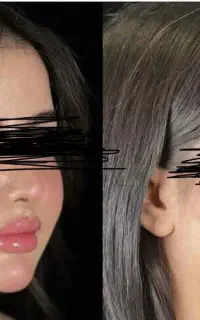 تخصص ما تزریق به سبک صورت عربی