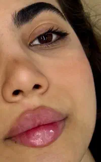 بوتاکس ژل لب مزونیدلینگ‌ لیفت صورت بانخ توسط پزشک