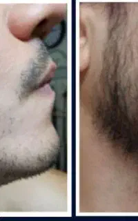 معجزه رویش مو و ریش