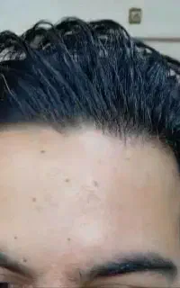 خال بردلری لک پک ماه کرفتی لیزر