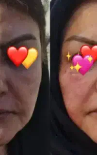 بوتاکس 1100ژل اودری800نخ لاغری1200وانزیم700مزوژل