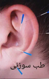 حجامت زالو درمانی خدمات طب سنتی و شکسته بندی