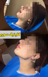 سوپر کانتور