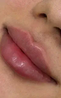 تزریق فیلر و بوتاکس