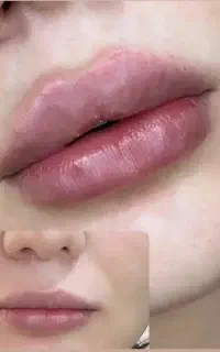 تزریق ژل بوتاکس فیلیر آنزیم