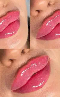 تزریق ژل . بوتاکس .جوان ساز