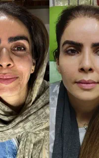 جذب مدل فیلر ژل لب و کل صورت برای تولید محتوا
