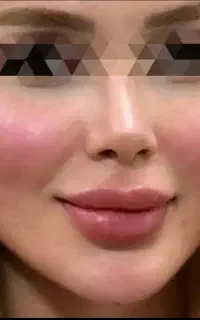 ژل لب کره‌ای کانتورینگ فول‌فیس بوتاکس چال گونه