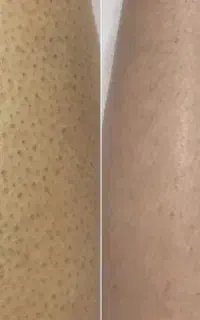 تنها لیزر تضمینی با ضمانت برگشت وجه