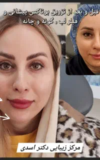 کلینیک زیبایی برای جوانسازی بوتاکس فیلر هایفو لیزر