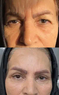 تخفیف ویژه بلفاروپلاستی با دستگاه لیزری