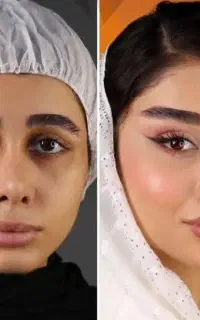 جراحی لیفت اندوسکوپ پیشانی وشقیقه ابرو وصورت متخصص