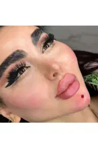تزریق وآموزش بوتاکس ژل لب گونه زاویه زیرچشم