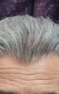 کاشت مو VIP با امکان اقساط ۱۰ ماهه