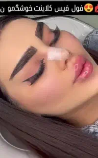 تخفیف ویژه ژل و بوتاکس