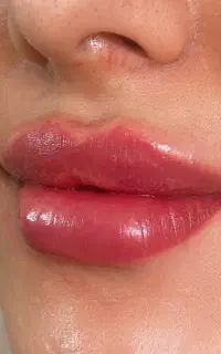 ژل لب کانتورصورت بوتاکس مزوژل جوانسازی آنزیم