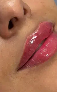 تخفیفات ۵۰٪کیلینیک زیبایی*ژل*بوتاکس*