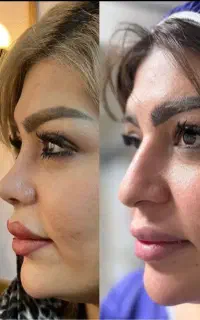 جراحی زیبایی بینی فقط با۲۹میلیون