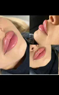 ژل و بوتاکس