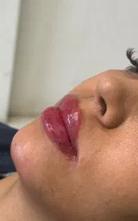 جشنواره فیلر بادی،بوتاکس، لیزر