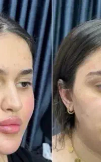 ژل و بوتاکس ۷۵۰.فول فیس ۵ت هایفو تخصصی .توسط پزشک