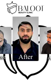 کاشت مو و ابرو با تخفیف ویژه و ضمانت کاشت