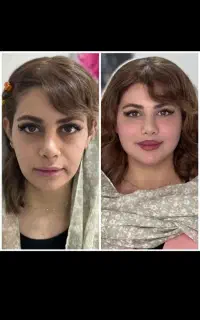 جشنواره تخفیف فیلر و بوتاکس