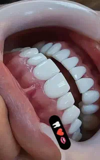 کامپوزیت روکش ترمیم جرمگیری